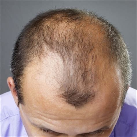 male pattern baldness